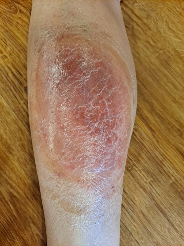A先生腿部皮膚炎症,先惡化後好轉,最終痊癒A先生腿部出現的皮膚炎症,在治療過程中曾一度惡化,但隨後顯著改善,最終完全康復。下方照片依時間順序由上至下排列,清楚呈現了皮膚逐步恢復的過程。