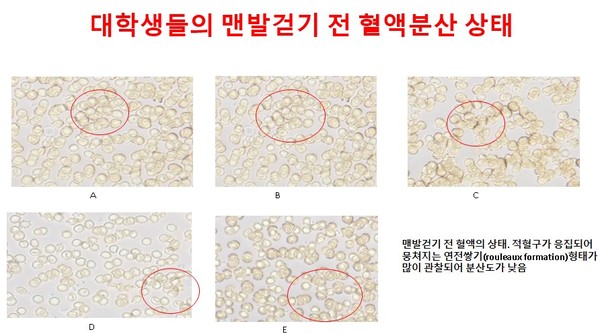맨발걷기 전 혈액의 상태. 적혈구가 응집되어 뭉쳐지는 연전쌓기(rouleaux formation)형태가 많이 관찰되어 분산도가 낮음.