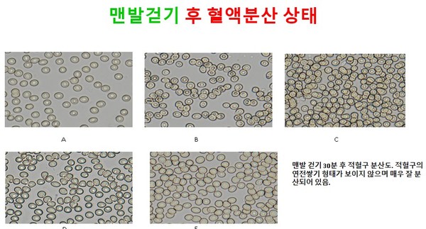 맨발걷기 30분 후 적혈구 분산도. 적혈구의 연전쌓기 형태가 보이지 않으며 매우 잘 분산되어 있음.