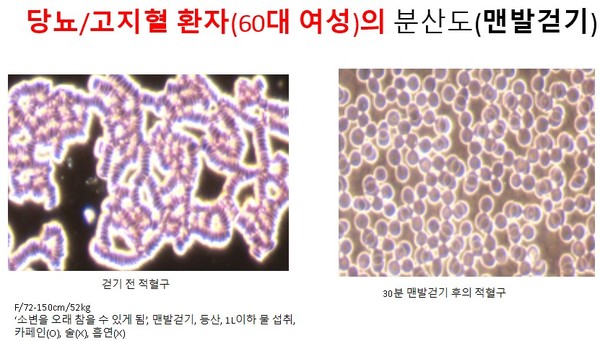 F/72-150cm/52kg‘소변을 오래 참을 수 있게 됨’, 맨발걷기, 등산, 1L이하 물 섭취, 카페인(O), 술(X), 흡연(X)